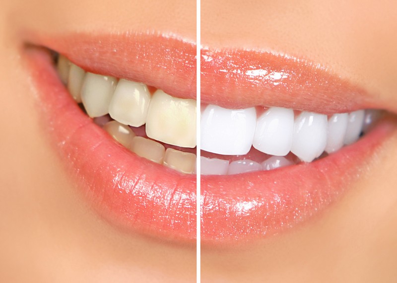 Teeth Whitening Hamilton, BM HMO